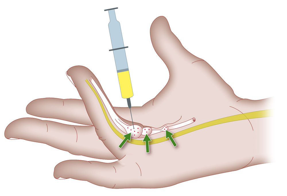 hand-operation-spritze hand-operation-spritze